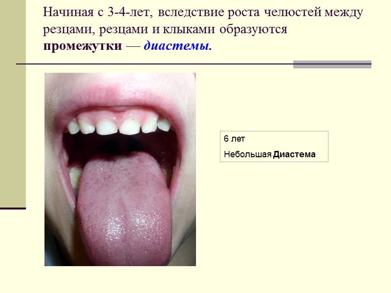 Начиная с 3-4-лет, вследствие роста челюстей между резцами, резцами и клыками образуются промежутки —